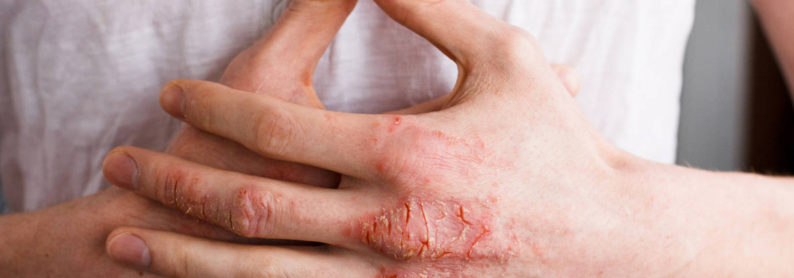 psoriasis en goutte